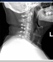 Cervical Spine X-ray