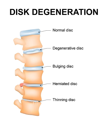 Lumbar Spine Problems  Expert Spine Surgeon in Boston MA