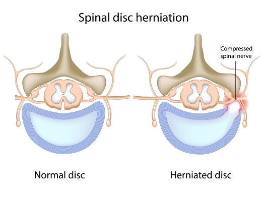 Spinal Disc Herniation